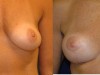 1a-breast-lift-and-implants-combined